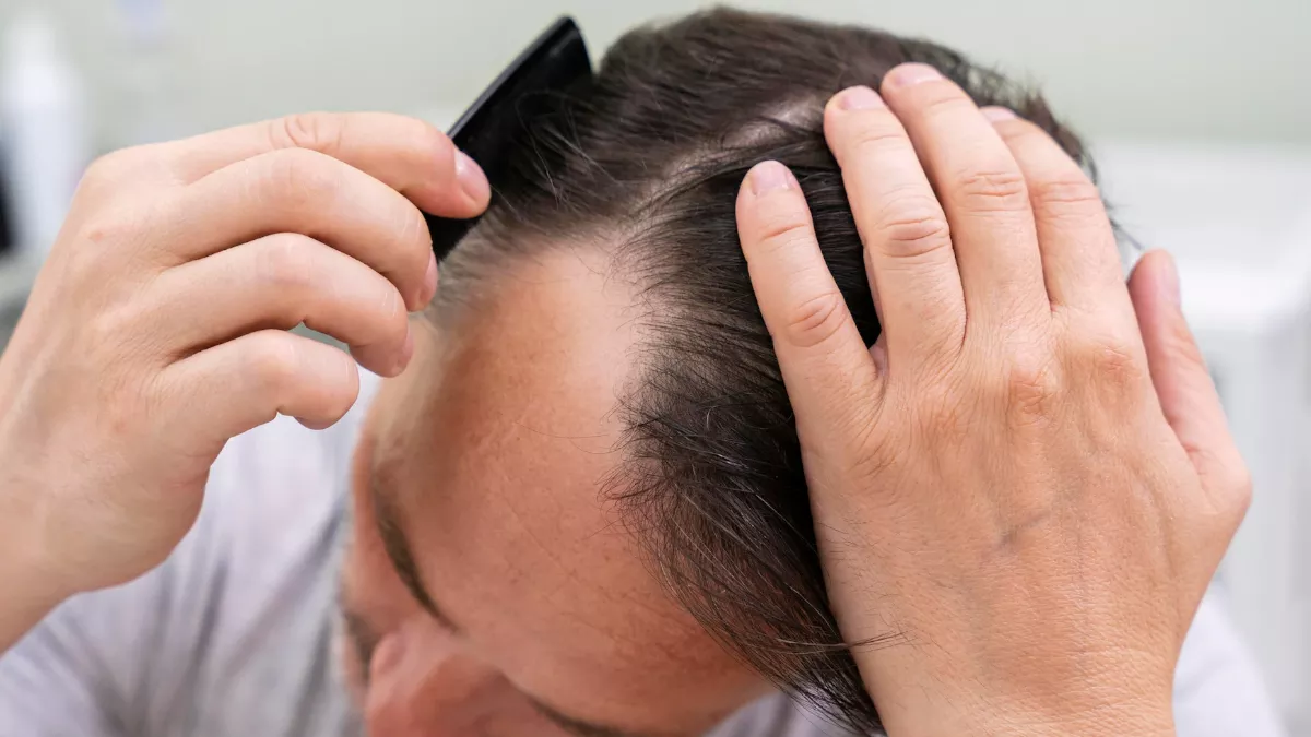 Alopecia areata: क्या है एलोपेसिया एरीटा, जानें क्या इसका इलाज है संभव?