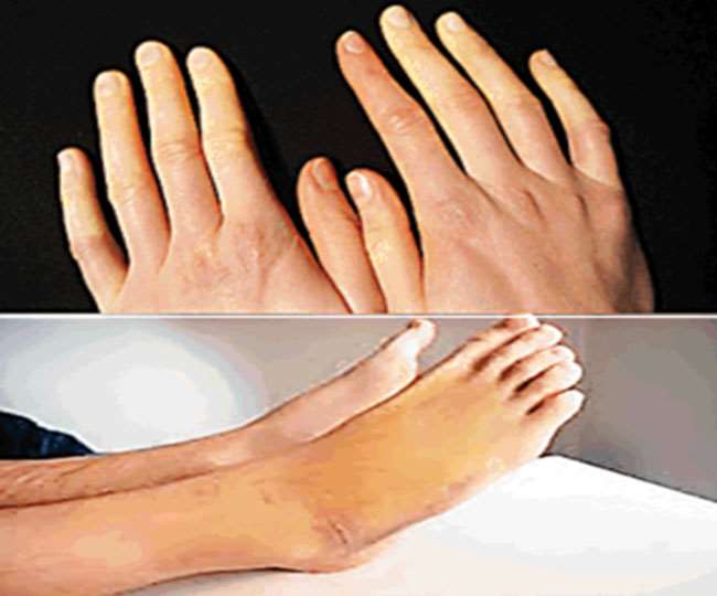 सावधान! ठंड में हाथों और पैरों में रंग तो नहीं बदल रहीं अंगुलियां, इस गंभीर बीमारी के हैं लक्षण