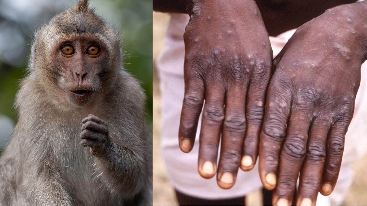 Monkeypox in India: दुनियाभर में तेजी से फैल सकता है मंकीपाक्स, बंदरों से ये है संबंध; भारत में भी बढ़ा खतरा